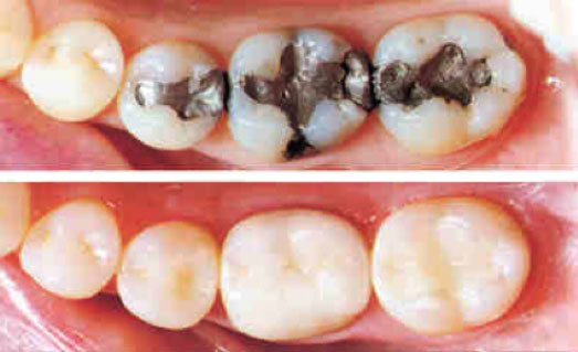 Restorative Dentistry and Dental Filings