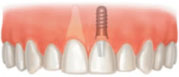 Single Missing Tooth