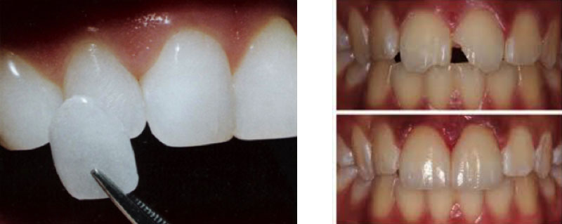 Veneers